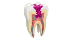 깊은 충치가 치수 조직까지 침범하는 과정을 보여주는 3D 의학 일러스트